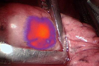 Malignant pulmonary nodule glowing during surgery Malignant pulmonary nodule glowing during surgery