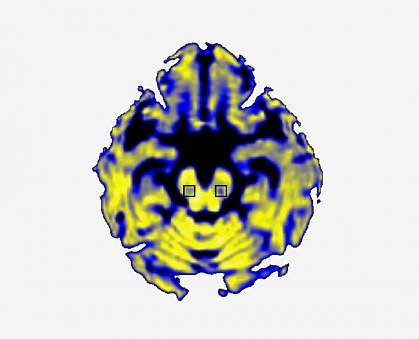 Image of a brain scan Image of a brain scan