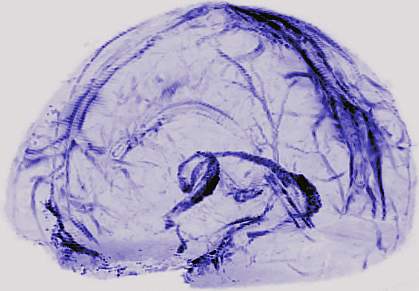 Lymphatic vessels in human brain Lymphatic vessels in human brain