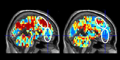 rain scans of suicide attempter and control participant Brain scans show different patterns between people who had attempted suicide and control participants