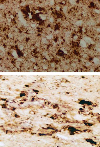 Diseased brain tissue Diseased brain tissue