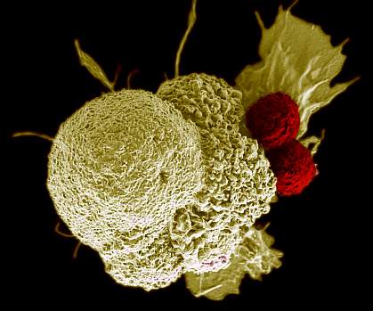 Cancer cell and T cells Scanning electron micrograph of a cancer cell being attacked by two T cells