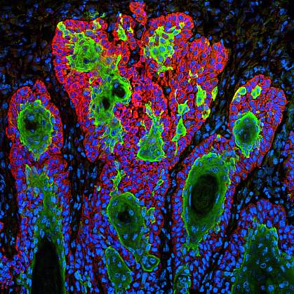 Squamous cell carcinoma Squamous cell carcinoma, a type of skin cancer