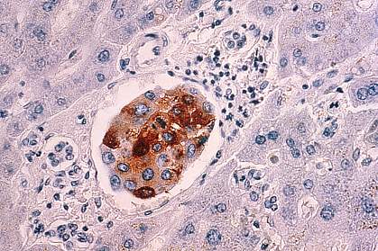 Malignant breast cancer cells in liver Malignant breast cancer cells in liver