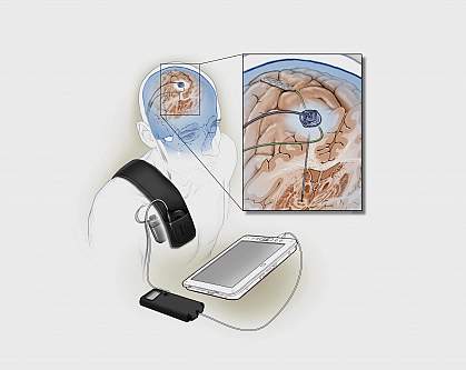 Illustration of implanted deep brain stimulation device Illustration of implanted deep brain stimulation device