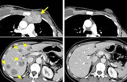 CT scans from cancer patient All cancerous growths have disappeared after 22 months.