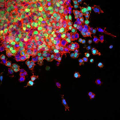 Lung cancer metastasis 