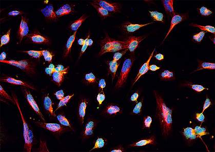 Microscopic image of cancer cells Microscopic image of cancer cells