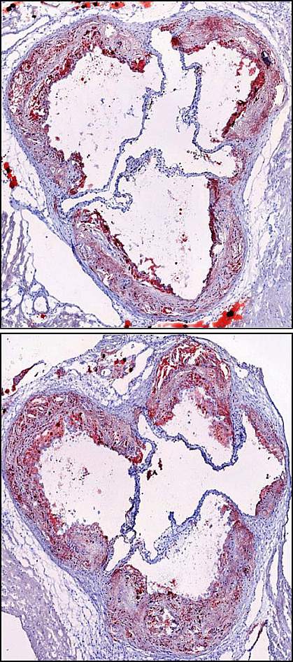 Plaque in two arteries Plaque in artery