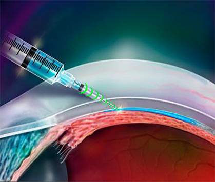 Resistance-sensing injector Illustration of resistance-sensing injector being used in an eye