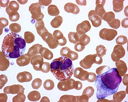 Microscopic image of eosinophils Microscopic image of eosinophils