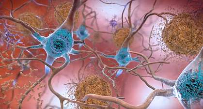 Illustration of nerve cells with plaques and tangles Illustration of nerve cells with plaques and tangles