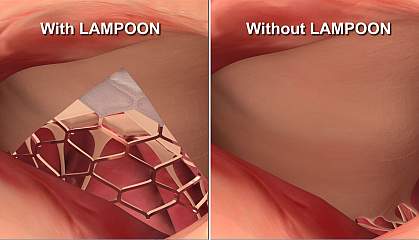 Illustration of heart valve leaflets with and without LAMPOON Illustration of heart valve leaflets with and without LAMPOON