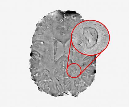 Brain MRI image highlighting a lesion with a dark outer rim Brain MRI image highlighting a lesion with a dark outer rim