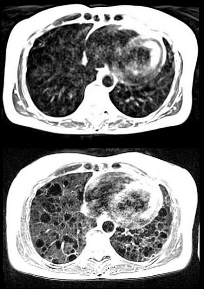 MRI scans MRI scans