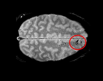 Brain scan showing microbleeds Brain scan showing microbleeds