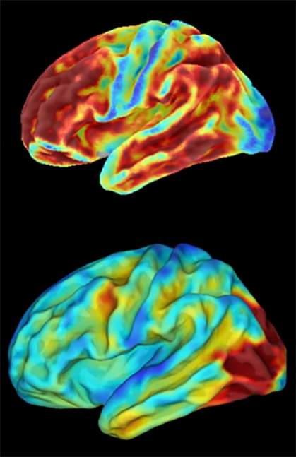 Brain images of woman with inherited condition that causes early-onset Alzheimer’s disease Brain images of woman with inherited condition that causes early-onset Alzheimer’s disease