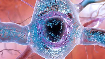 Illustration of neuron with tau tangles Illustration of neuron with tau tangles
