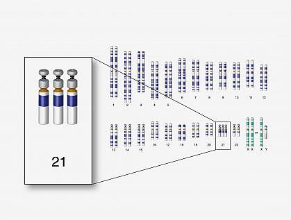 Down syndrome chromosome set Down syndrome chromosome set