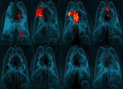 Image of PET-CT lung scans Image of PET-CT lung scans