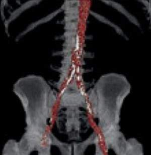 Aortic calcification in CT scan Schematic of aortic calcification in CT scan