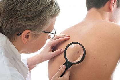 Dermatologist examining a mole on a person’s back Dermatologist examining a mole on a person’s back