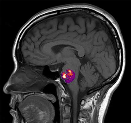 Brain scan Cavernous angioma on brain scan