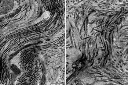 Electron micrographs of scar tissue Electron micrographs of scar tissue