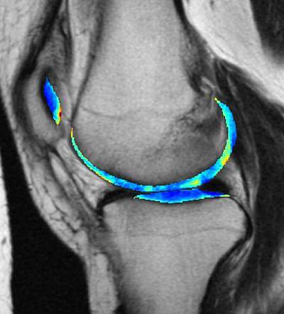 MRI of knee cartilage MRI of knee cartilage