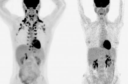 PET scans with brown fat PET scans with brown fat