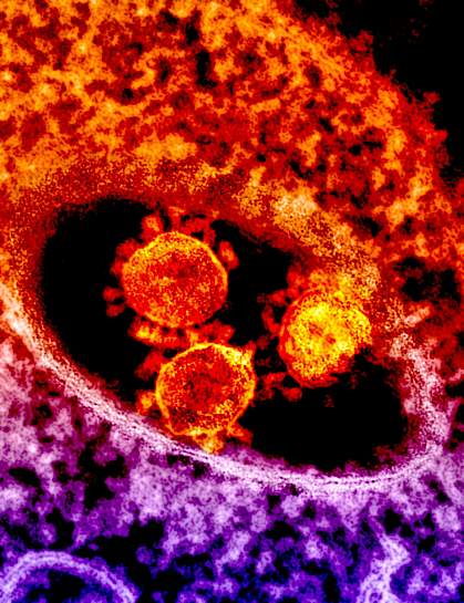 MERS coronavirus particles MERS coronavirus particles