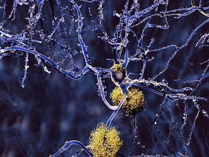 Neurons with amyloid plaques