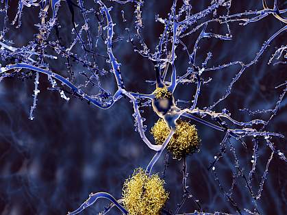 Neurons with amyloid plaques Neurons with amyloid plaques