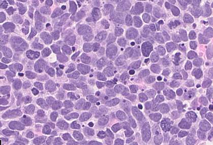 Small-cell lung carcinoma cells Small-cell lung carcinoma cells