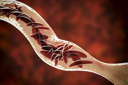 Clumped sickle cells in a blood vessel Clumped sickle cells in a blood vessel