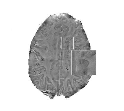 MRI scan of a human brain with multiple sclerosis MRI scan of a human brain with multiple sclerosis