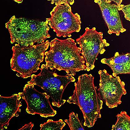 Metastatic melanoma cells Metastatic melanoma cells