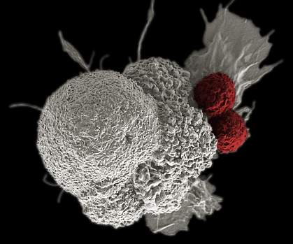 Scanning electron micrograph of cancer cell being attacked by T cells Scanning electron micrograph of cancer cell being attacked by T cells