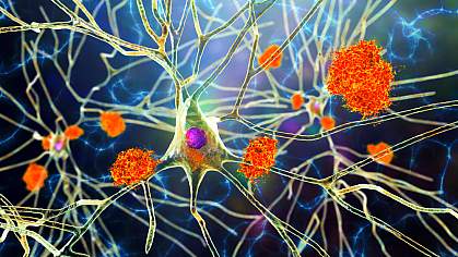 Illustration showing clumps of amyloid around a branched neuron Illustration showing clumps of amyloid around a branched neuron
