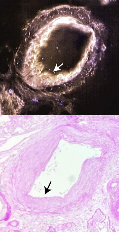 Artery in human kidney tissue MediSCAPE image clearly shows plaque on artery wall that can’t as easily be seen in other image.