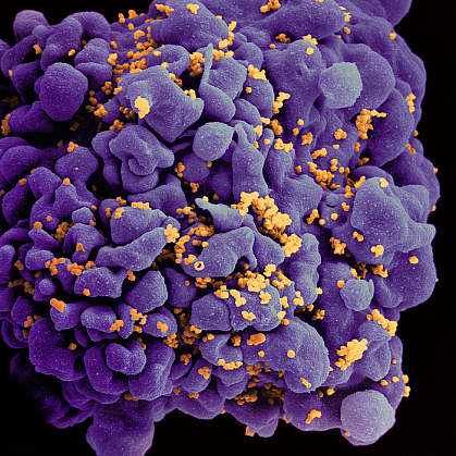 T cell covered with numerous virus particles T cell covered with numerous virus particles