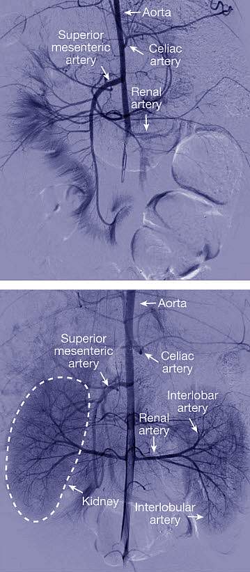 Perfused kidneys Small blood vessels appear after treatment with OrganEx, but not with the standard machine