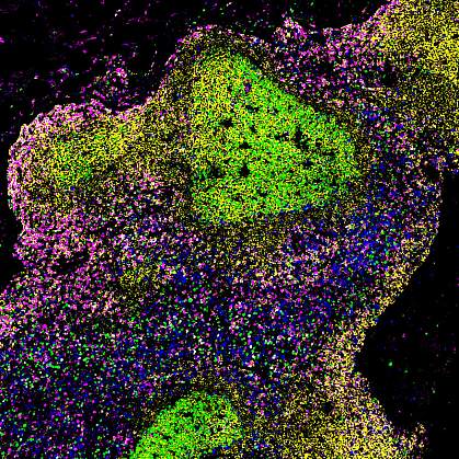 Lymph node of person with untreated HIV Fluorescent microscope image with dense area of green cells