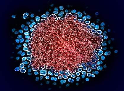 Numerous HIV particles surrounding a cell, with some emerging from it Numerous HIV particles surrounding a cell, with some emerging from it