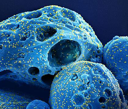 Cell with numerous SARS-CoV-2 virus particles Cell with numerous SARS-CoV-2 virus particles