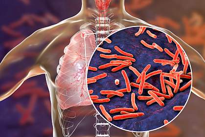 Mycobacterium tuberculosis bacteria in lungs Mycobacterium tuberculosis bacteria in lungs.