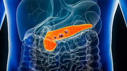 Illustration of pancreas with tumors. Illustration of pancreas with tumors.