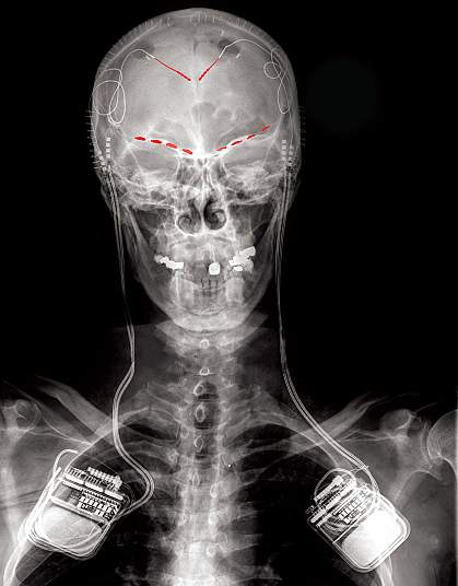 X-ray shows recording devices in both shoulders with electrodes at the top of the brain and above the eye sockets. X-ray shows recording devices in both shoulders with electrodes at the top of the brain and above the eye sockets.