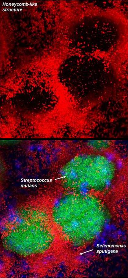 One panel shows a honeycomb-like structure in red made of Selenomonas sputigena. The other panel shows Streptococcus mutans, in green, filling the gaps in the structure. One panel shows a honeycomb-like structure in red made of Selenomonas sputigena. The other panel shows Streptococcus mutans, in green, filling the gaps in the structure.