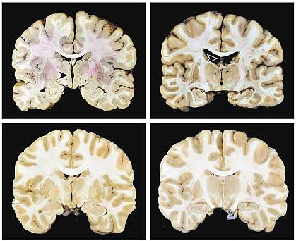 The top left image shows a notch at the center of the brain; the top right image shows a void near the upper center. Both abnormalities are absent in the control brain images.
